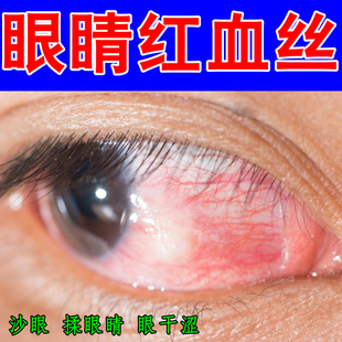 眼睛红血丝分泌物增多粘稠干涩流泪冶眼里有异物去眼屎去黄滴眼液