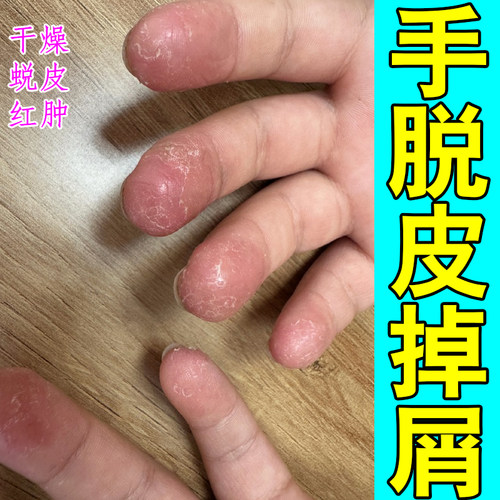 手背粗糙裂口起皮发硬角质堆积纹路杂乱紧绷干涩泛红脱皮干燥缺水