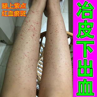 紫点色素过敏瘀斑瘀点紫斑皮下出血腿上长红点老年色素瘀滞单纯性