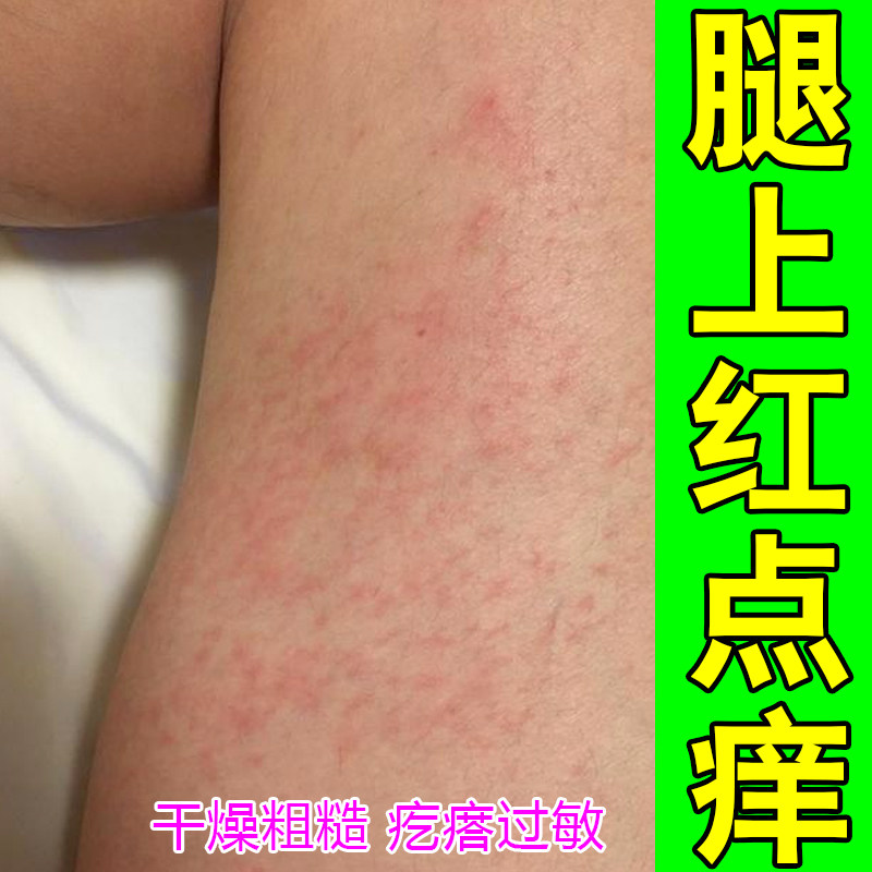 腿上红点痒皮肤季节性过敏换季皮肤粗糙干燥痒掉屑红肿大腿内红斑