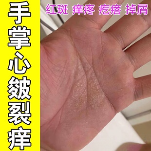 手掌心皴裂痒真菌手指起硬疙瘩痒角质化粗糙疙瘩干燥专用修复保湿