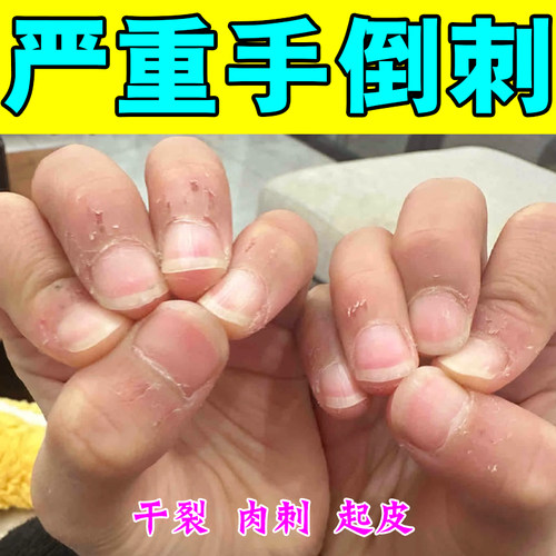 修复手上上倒刺儿童防肉刺疼痛手干裂脱皮起硬皮修复霜滋润手指裂