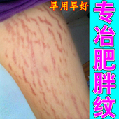 专冶肥胖纹生长纹消大腿红白纹路学生男女淡化纹路祛肥胖纹修复膏