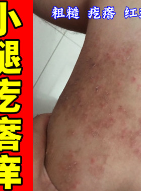 小腿大腿内侧干痒疙瘩痒起红斑长红点粗糙一挠就痒干燥红疙瘩专用