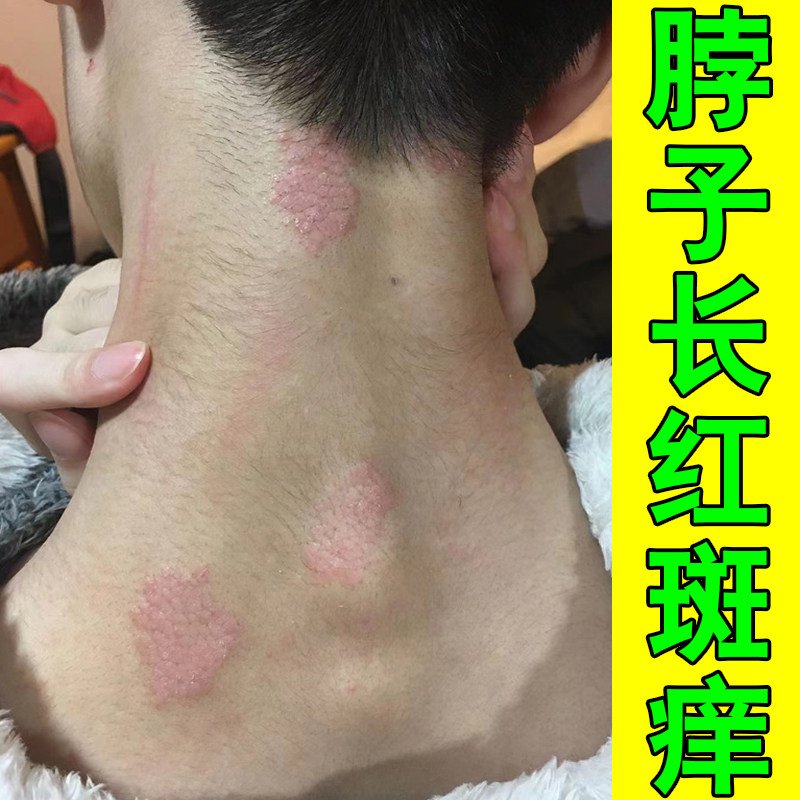 脖子长红斑痒紫外线过敏神经性换季过敏太阳晒起红疹颈部长红疙瘩