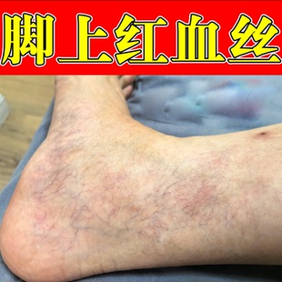 腿上有红血丝青筋凸起毛细血管扩张腿部下肢血管不流通疏通