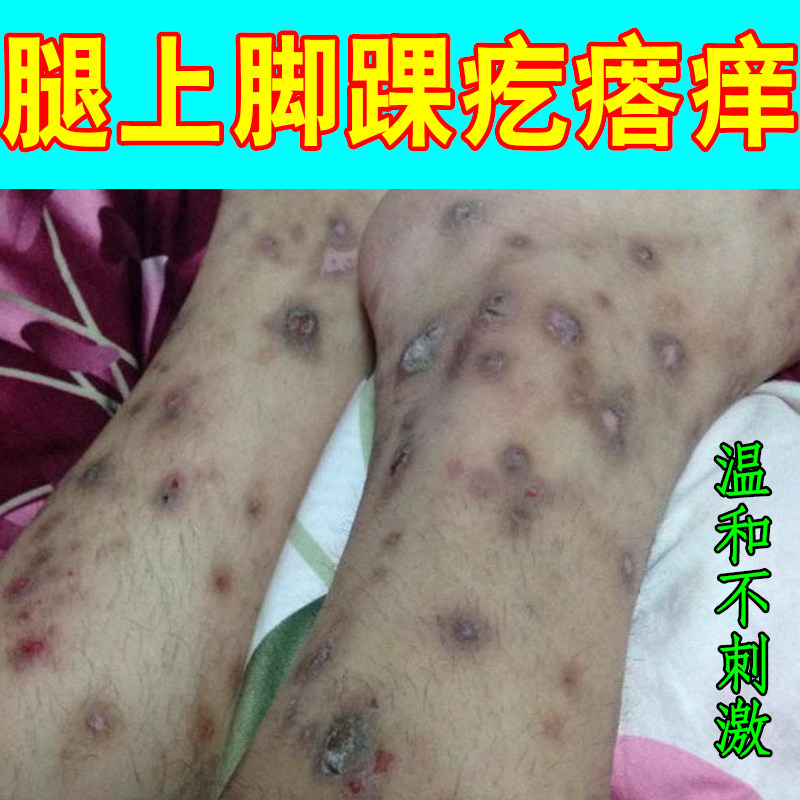 腿上脚踝疙瘩痒身上皮肤起硬块痘痘感染小腿痒胳膊上长红点草本药