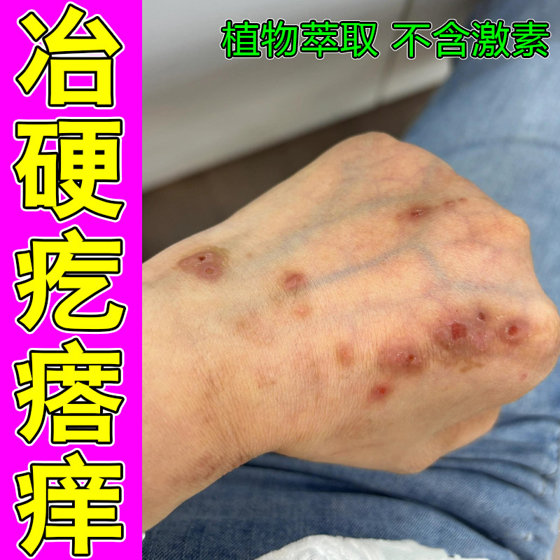 冶硬疙瘩痒身上皮肤粗糙干燥鳞屑长硬块脓包一挠就痒红肿过敏干燥