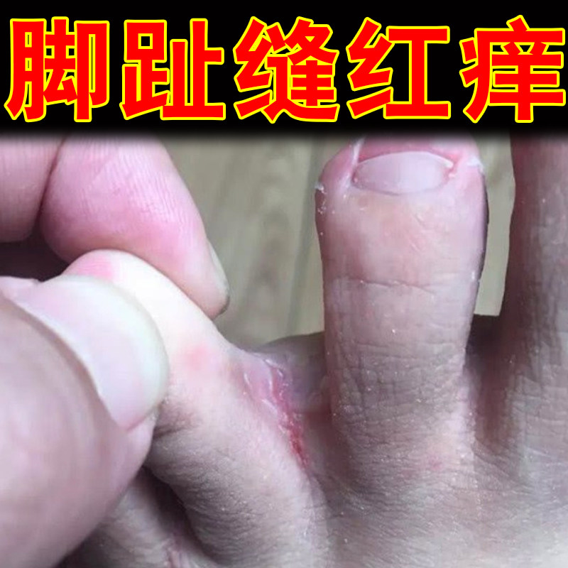 脚趾缝红痒脚底泛白窝状脚底长小水泡感染脚后跟干裂角质层掉屑痒