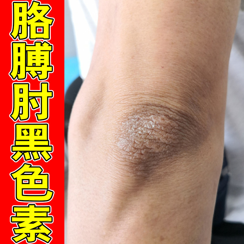 胳膊肘黑色素淡化脖子黑皮肤干燥膝盖黑手肘关节黑洗不干净去死皮