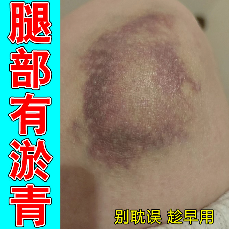 小腿大腿外力撞击乌青块皮下暗紫色淤痕没磕碰也出现色块按压发闷
