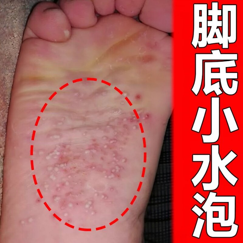 脚底上起小水泡又i痒又脱皮脚掉皮型