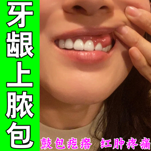 牙龈长脓包牙根尖上鼓包肿痛智齿发炎上火儿童出血干燥专用修复药
