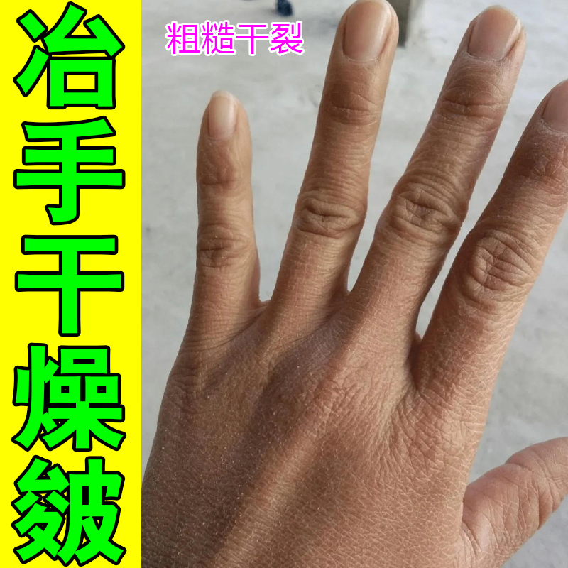 美隆手背干燥开裂修护护手霜药乳