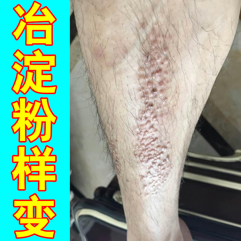 皮肤粗糙颗粒褐色蛋白沉积顽固黑色素沉淀小腿痒老年人身上痒膏