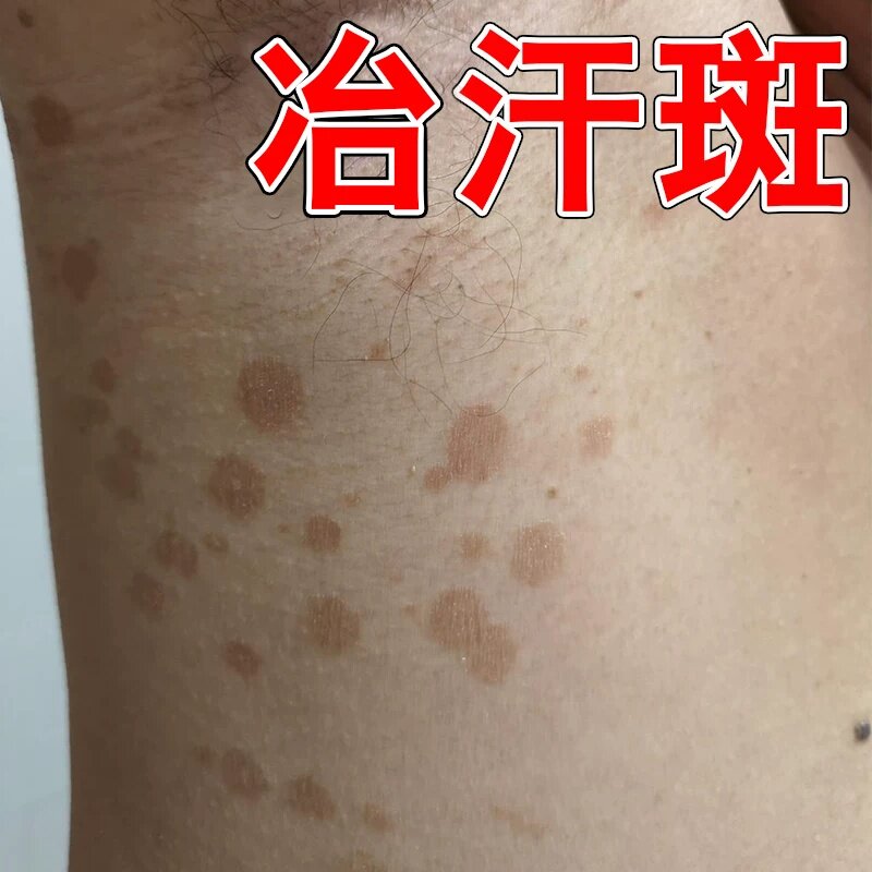 汗斑净花斑专效褐色白斑后背用特去腋下汉斑痒膏药