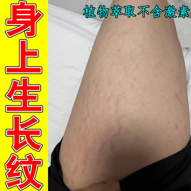 身上生长纹大腿学生肥胖纹白色纹路青春期腰胯红紫色纹妊娠纹草本