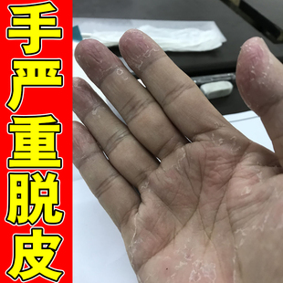 手指脱皮儿童手蜕皮严重干裂手裂口子干燥粗糙手上起皮药