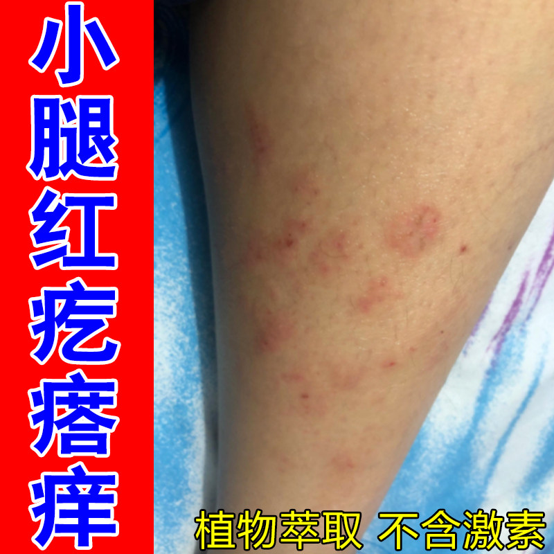 小腿红疙瘩痒掉屑粗糙干燥痒皮肤过敏长红斑红肿老年人身上痒刺挠