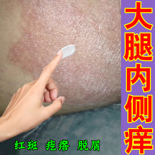 大腿内侧痒两侧红斑冶身上长红点疙瘩痘痘私处痒阴囊潮摩擦出汗痒