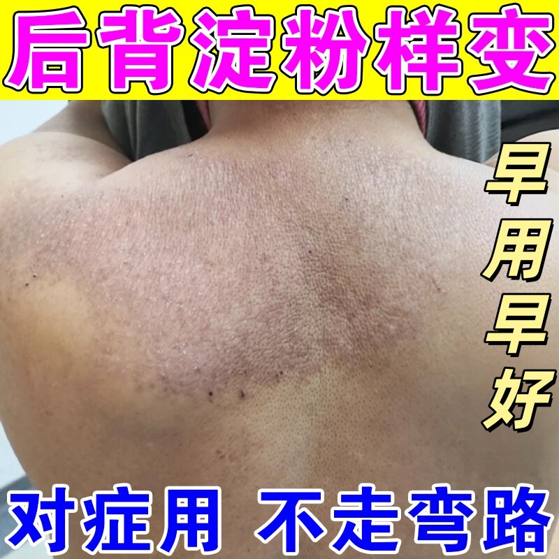 药疗顽固后背黑色素沉淀小腿痒褐斑状粗糙疙瘩
