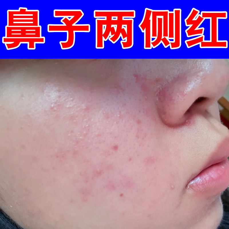 鼻子两侧红鼻周长疙瘩红肿痘过敏脂溢性酒糟鼻去螨虫鼻修护保湿药