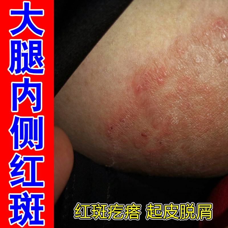 大腿内侧红斑红肿刺痛潮湿皮肤红点长疙瘩屁股痘痘专用膏