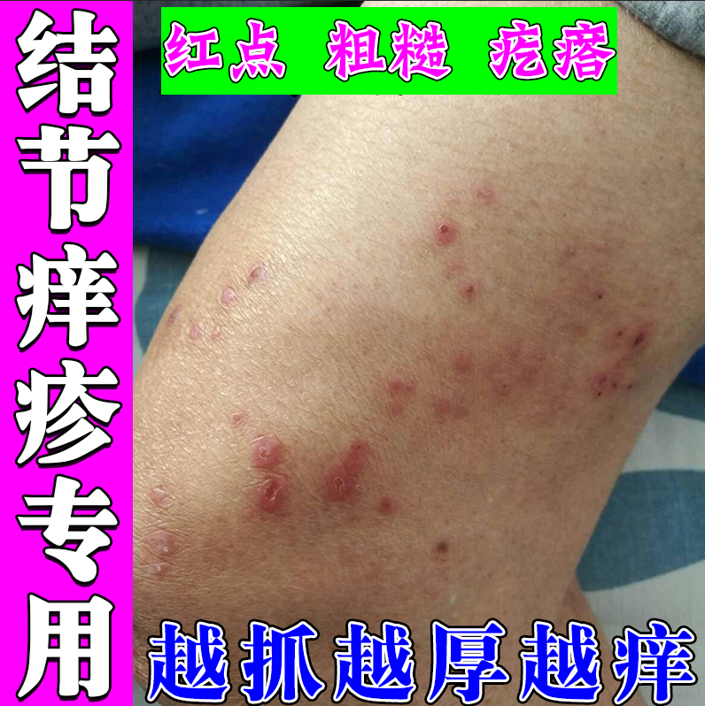 小腿胳膊痒起红疙瘩红斑顽固硬疙瘩红肿硬块痒膏