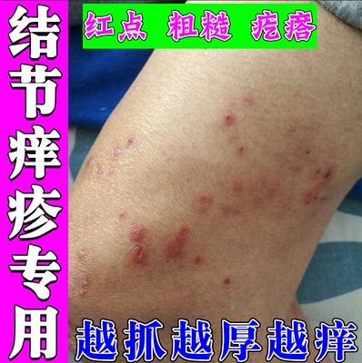 小腿胳膊痒起红疙瘩红斑顽固硬疙瘩红肿硬块痒膏