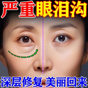 泪沟填充神器去除眼袋修复法令纹眼窝凹陷提亮提拉贴跟泪沟说拜拜