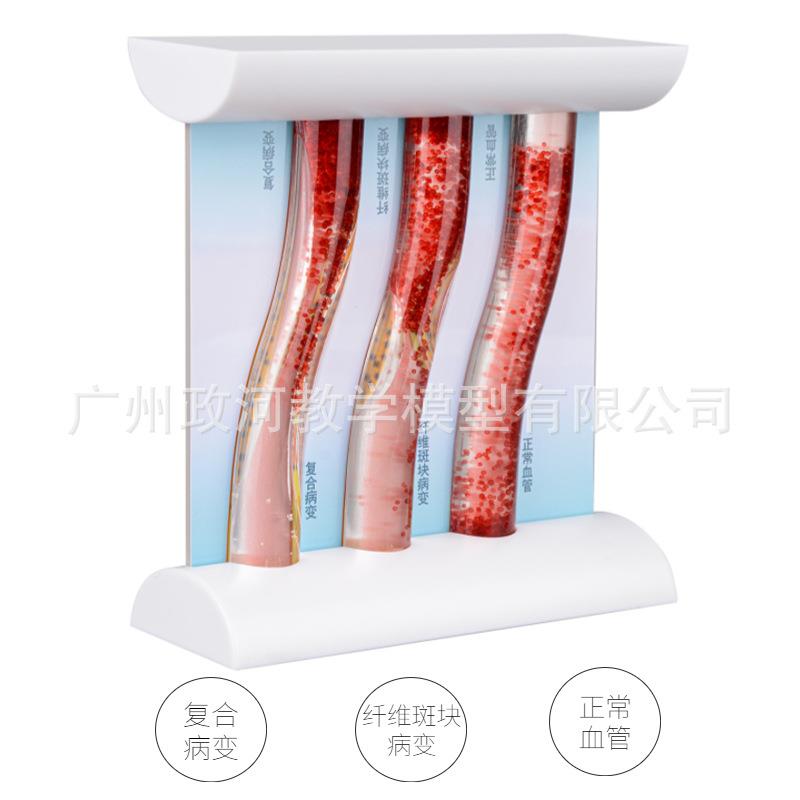 新款直销动态高血脂血管堵塞对比模型态病理血管对比模型浓稠度对
