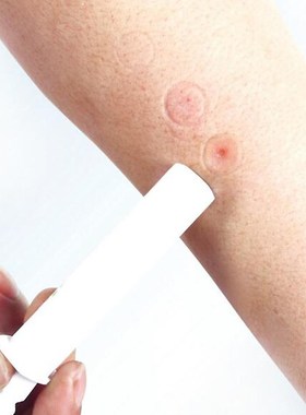 Mosquito Bites Itching Instant Bug Bite Relief Extraction Va