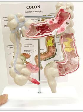 大肠病理DKH体模型大肠道模型大病变肠模型肠疾病人结肠病变模型