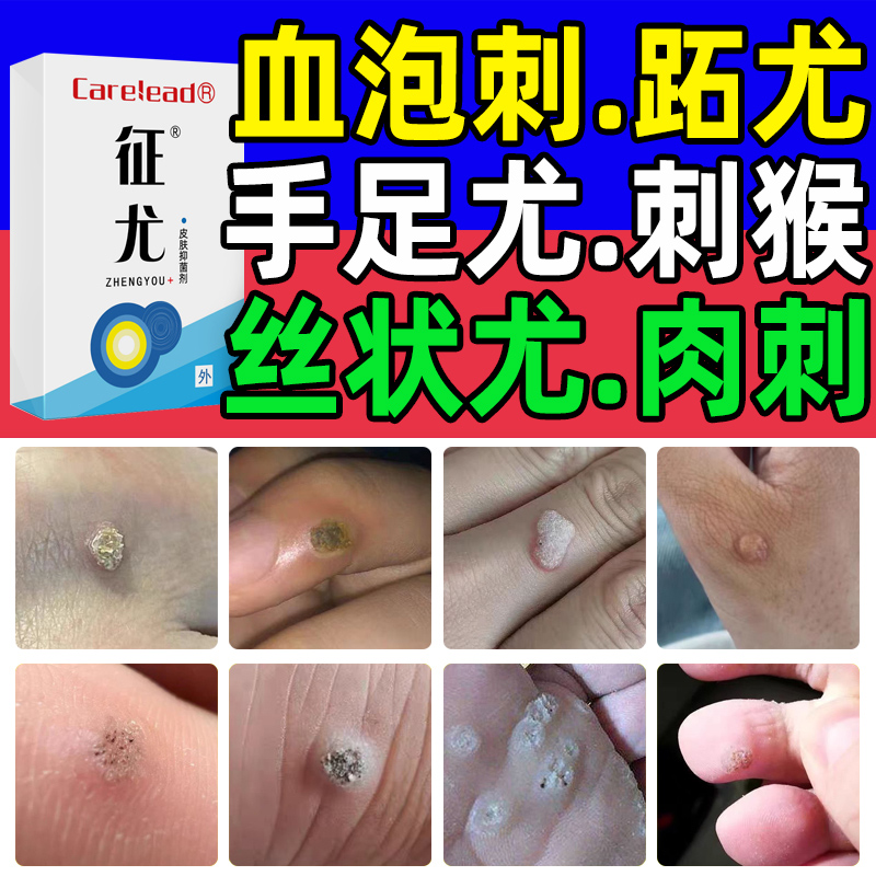 刺猴血胞刺老鼠痣鱼鳞痣