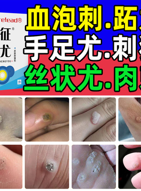 征尤瘊子刺猴趾血泡刺贴血胞刺拓跖疣老鼠痣鱼鳞痣祛非药水去除膏