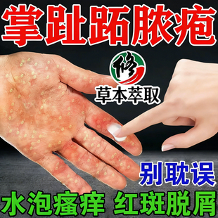 掌趾脓疱症掌跖脓包角化症治疗手脚脓包干裂脱皮角皮症专用药膏