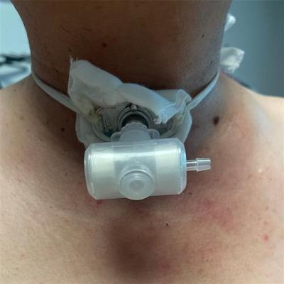 金属气切套管转接头转接人工鼻呼吸机说话瓣膜语音阀