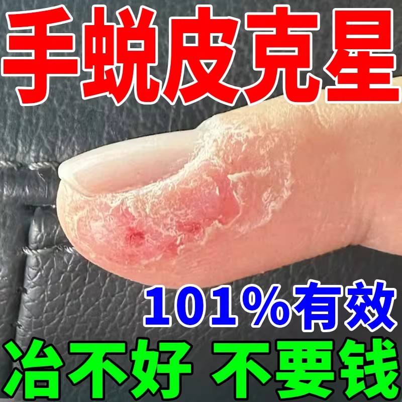 手足脱皮专用药膏正品治手指手掌真菌蜕皮干裂起皮脚底开裂脱皮药