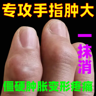 手指骨节粗大疼痛手指关节疙瘩鼓包手指肿大消肿手指关节疼痛