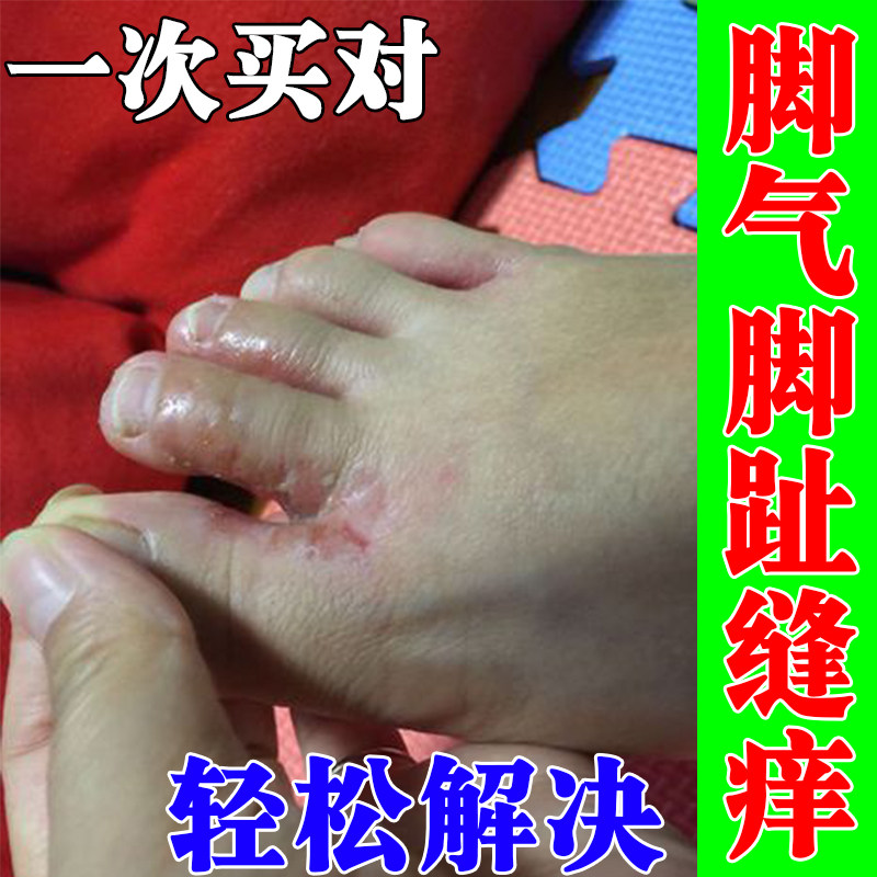 脚趾缝烂痒烂脚丫脚指间分离糜烂红肿脚气脱皮脚臭香港脚蜕皮干裂