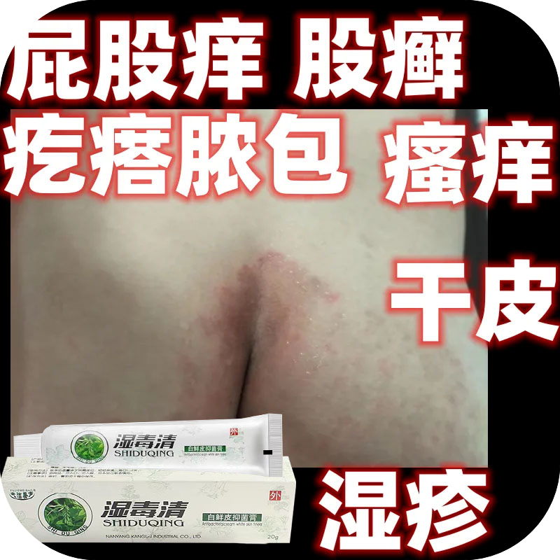 屁股痒坐疮膏屁股上有疙瘩久坐长痘痘生板疮起痱子屁股红热乳膏