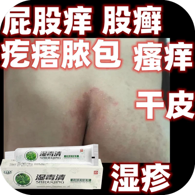 屁股痒坐疮膏屁股上有疙瘩久坐长痘痘生板疮起痱子屁股红热乳膏