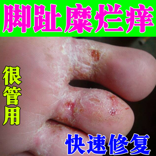 脚趾缝糜烂药烂脚丫干裂脱皮掉皮溃烂发白水泡型脚藓脚指头痒软膏