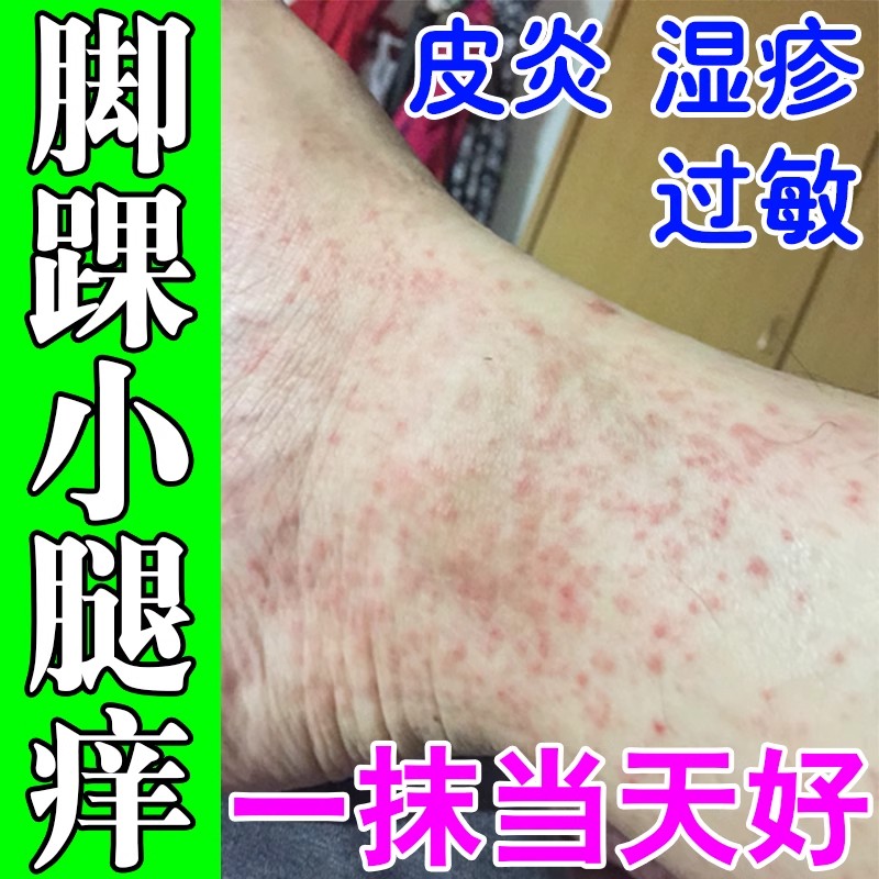 脚踝瘙痒脚背痒药膏脚杆脚脖子小腿上起小红点长疙瘩过敏止痒抑菌