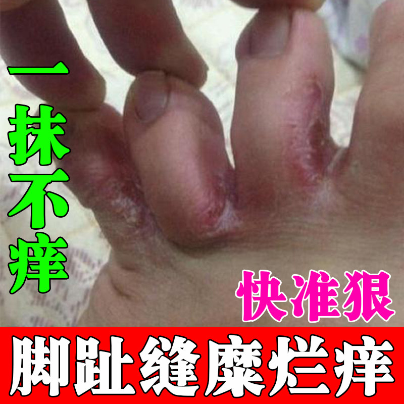 脚气烂脚丫药脱皮糜烂脚趾缝烂痒皮肤消毒护理（消）