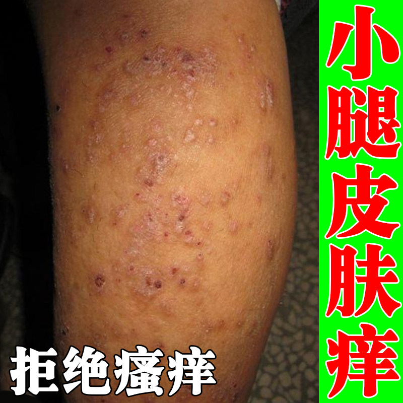 身上皮肤痒起红疙瘩长小红点治疗小腿痒的药全身干燥起皮过敏红疹