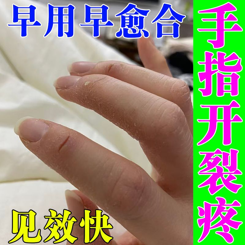 手裂口干裂修复霜秋冬指甲缝干裂防手指裂口开裂脱皮痒真菌感染药
