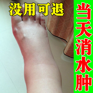脚肿消肿的药治专用老人去下肢小腿部水肿浮肿利尿排水特效神器疗