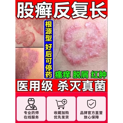 盐酸特比萘芬乳膏正品凝胶治体特股藓专用药膏止痒抑菌皮肤外用sp