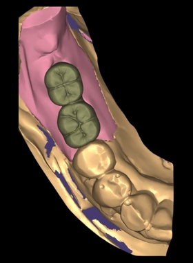 exo 3shape义齿代设计，竭诚为你服务，